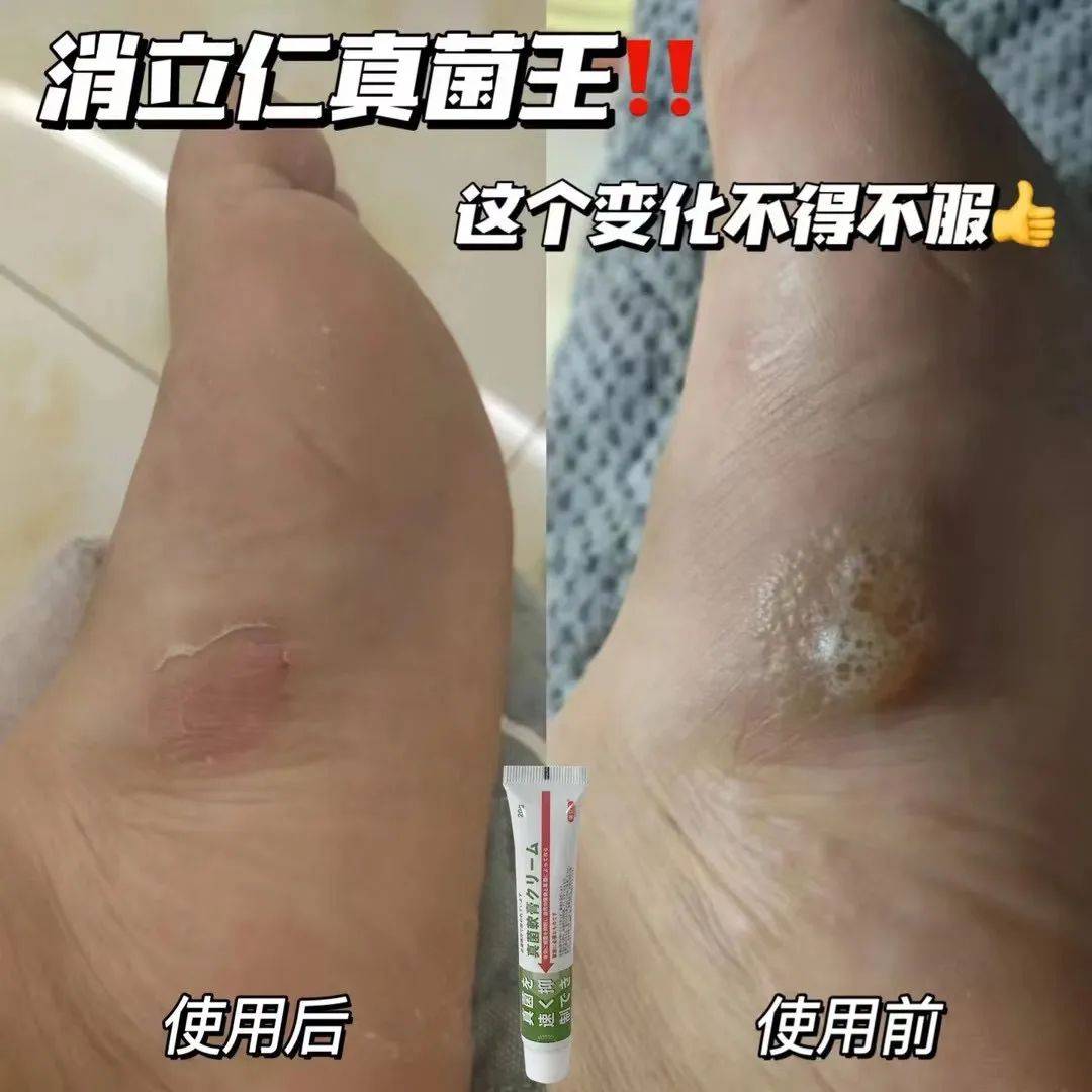 全网热销25w+！累计好评20w+的抑菌膏真有这么牛？！
