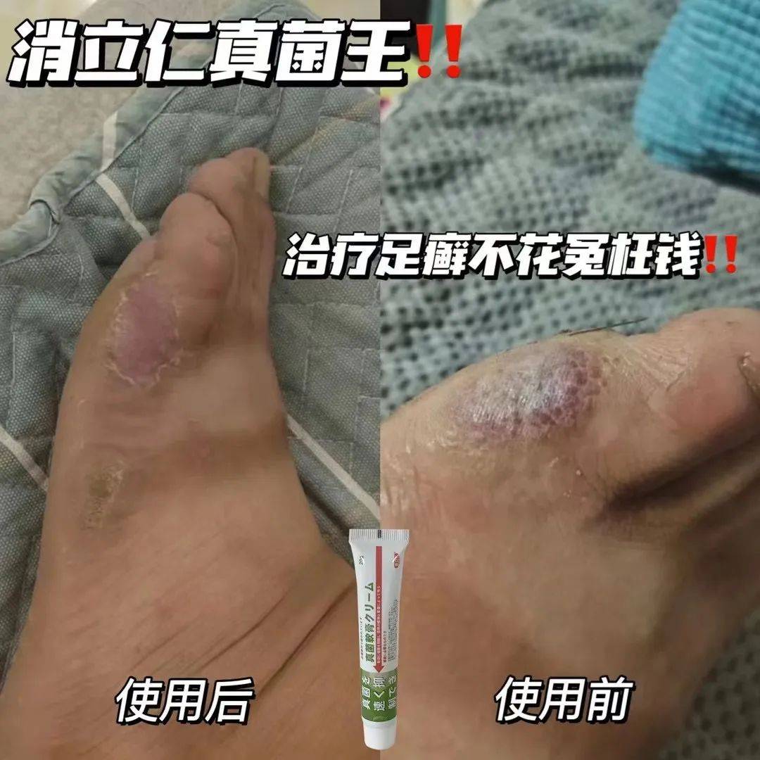 全网热销25w+！累计好评20w+的抑菌膏真有这么牛？！